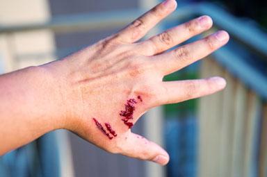 Injured hand showing fresh dog bite wounds in Fayetteville, GA legal case context