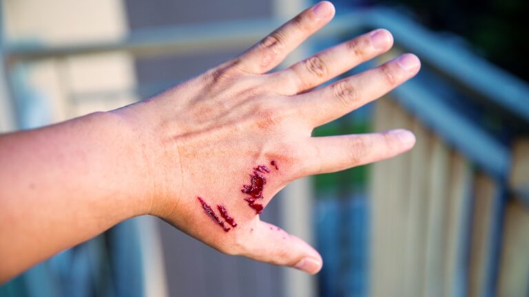 bite from a dog